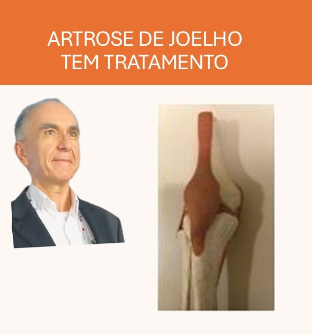 DICA IMPORTANTE: ARTROSE DE JOELHO TEM TRATAMENTO