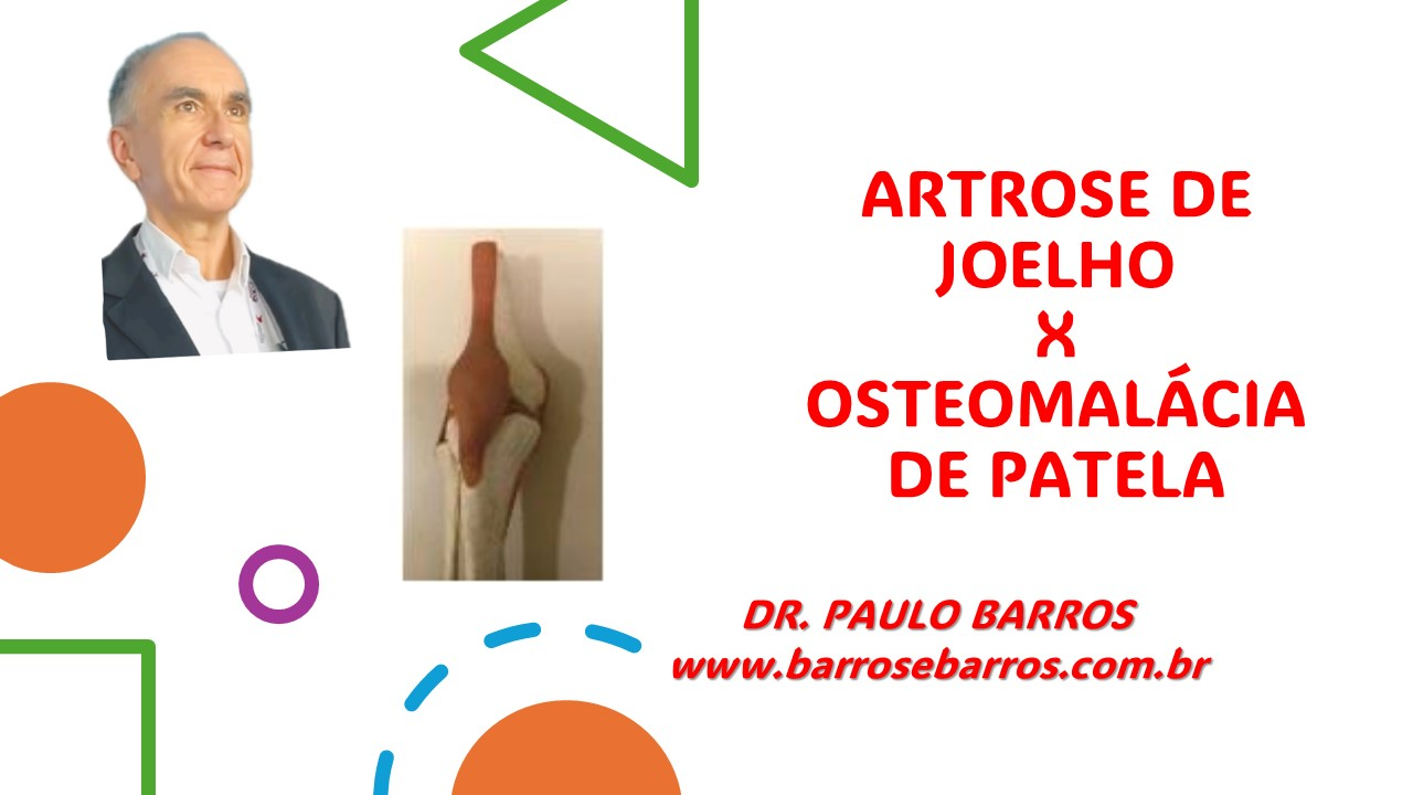 DIFERENÇA ENTRE ARTROSE DE JOELHO E OSTEOMALÁCIA DE PATELA